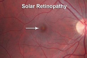 solar retinopathy